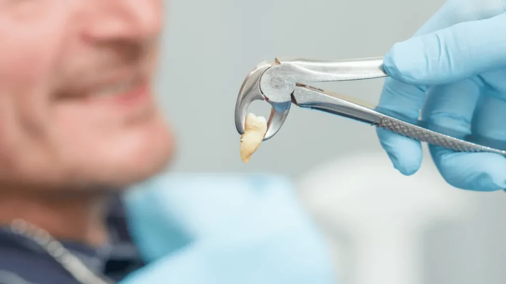 Painless Tooth Extraction
