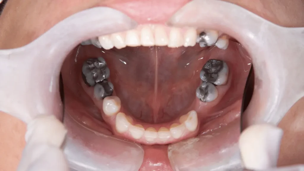 Full Mouth Rehabilitation