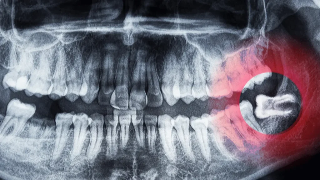 Impacted Wisdom Tooth Management