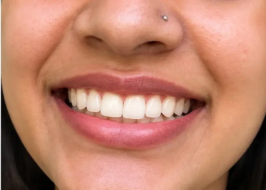 Smile Correction After E1777706388602