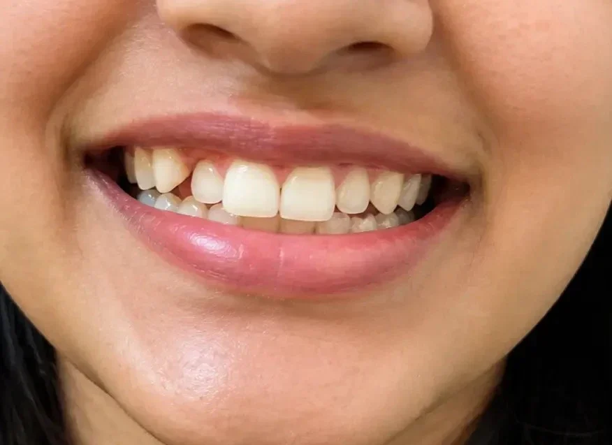 Smile Correction Before E1777706293443